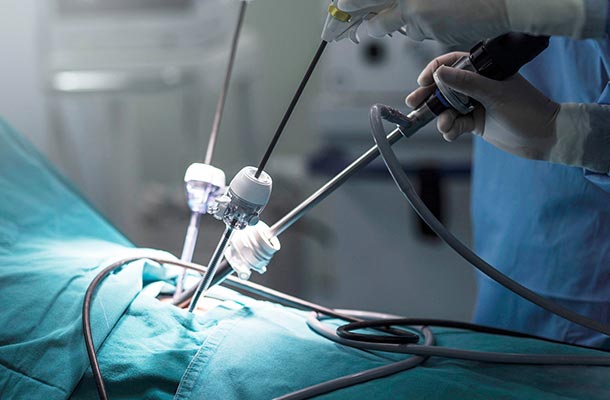 لاپاراسکوپی