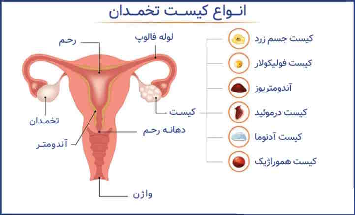 انواع کیست تخمدان