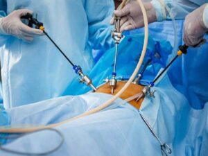 لاپاراسکوپی