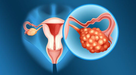 کیست تخمدان