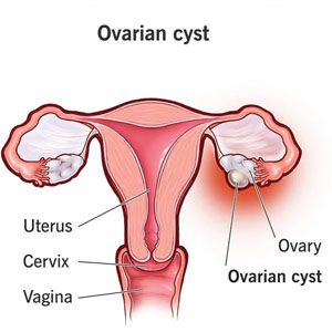 محل قرار گیری کیست تخمدان