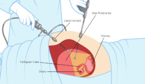 جراحی لاپاراسکوپی رحم چگونه انجام می‌شود؟