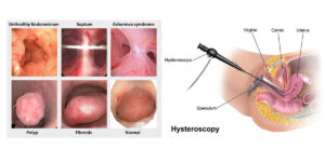 فرایند انجام هیستروسکوپی رحم