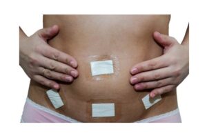 جراحی لاپاراسکوپی رحم؛ از ترس عمل تا بهبودی معجزه ‌آسا در چند روز