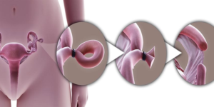 مراحل انجام توبکتومی