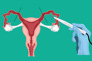 توبکتومی چگونه انجام می شود؟