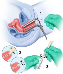 مراحل انجام تست پاپ اسمیر