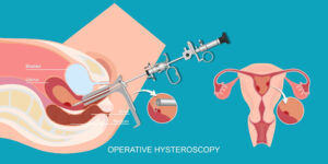 هیستروسکوپی رحم چگونه انجام می شود؟