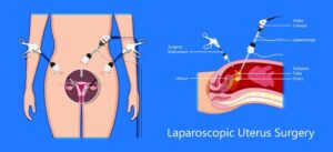 عمل لاپاراسکوپی زنان چگونه انجام میشود؟