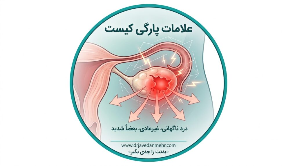 پارگی کیست تخمدان