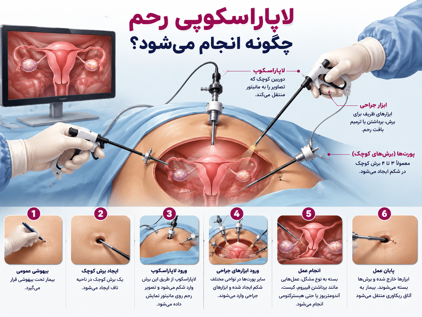 لاپاراسکوپی رحم چگونه انجام می شود ؟ 